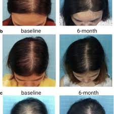 Microneedling and low level laser therapy for hair loss. Comparison Of Low Level Light Therapy And Combination Therapy Of 5 Minoxidil In The Treatment Of Female Pattern Hair Loss