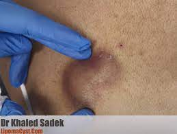 infected cysts prevention and early