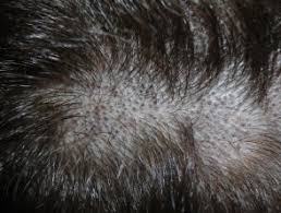 Fungal hair loss is a condition where a number of fungi on the scalp can lead to you losing your hair. Tinea Capitis Dermnet Nz