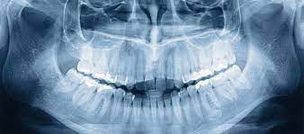 Sie ist ein standardoperationsverfahren der chirurgischen zahnerhaltung: Wurzelspitzenresektion Zahnarzt Selters Westerwald