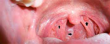 mouth cancer and lesions