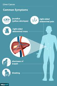 liver cancer signs symptoms and