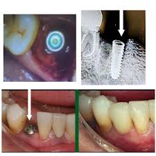dental implant specialist in pune