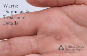 warts diagnosis and treatment details