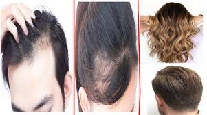 They continue to shed viable microbes. What Is The Best Treatment For Hair Loss Quora