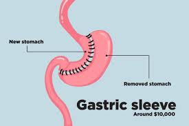 gastric sleeve surgery top weight loss surgery procedures