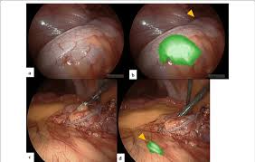 intraoperative findings a white light