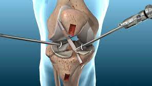an acl reconstruction