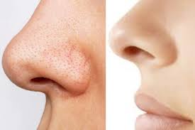 home remes to get rid of blackheads