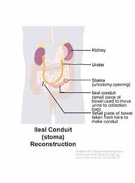 During an ileal conduit procedure, your surgeon creates a new tube from a piece of intestine that allows your kidneys to drain and urine to exit the body through a small opening called a stoma. Coping With Your Urinary Reconstruction Cancer Support Community