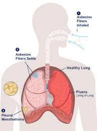 Adenocarcinoma cancers being usually in one of the following organs: Mesothelioma What To Know About Malignant Mesothelioma Cancer