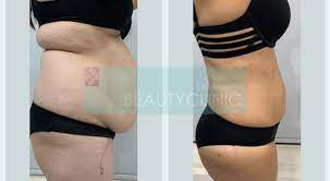 stomach liposuction before and after