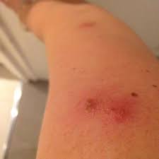 Infected bed bug bites - Picture of Delta Hotel Amsterdam City Centre -  Tripadvisor