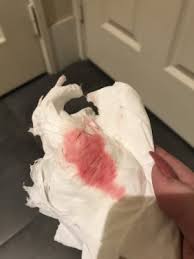 It should, however, only be a little pink cervical discharge rather than a real 'bleed'. Pink Discharge At 5 Weeks January 2018 Babycenter Australia
