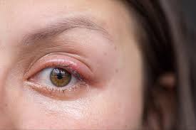 dry skin around eyes causes treatment