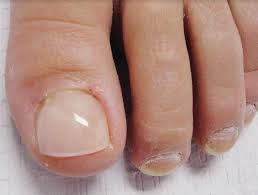 adelaide nail restoration keryflex