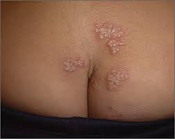 Most likely it is a recurrent infection, not the initial one; Recurrent Rash Mdedge Family Medicine
