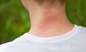 mosquito bite allergy symptoms