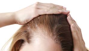 And severe dryness can cause breakage due to lack of elasticity. The Best Natural Shampoos For Hair Loss 100 Pure