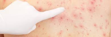 health tip avoid winter skin rashes