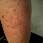 brown spots on legs and feet the