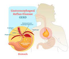 gastroesophageal reflux disease gerd