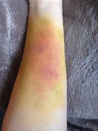 skin ilrator vs bruise wheel