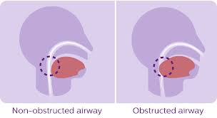 Image result for sleep apnea