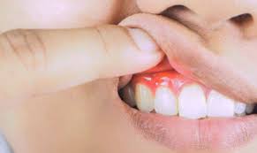 prevent gum diseases