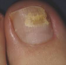 toenail fungus hinsdale foot ankle