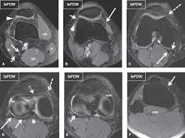 Magnetic resonance imaging (mri) interpretation of the knee is often a daunting challenge to the student or physician in training. The Knee Musculoskeletal Key