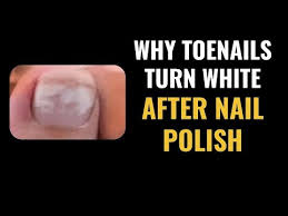 white toenails after nail polish