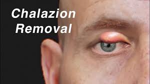 chalazion eyelid cyst removal