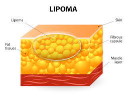 lipomas causes treatment methods