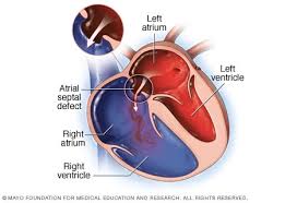 Atrial Septal Defect Asd Symptoms And Causes Mayo Clinic