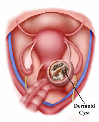 ovarian dermoid cysts ovarian