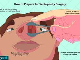 septoplasty surgery how to prepare