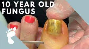 toenail removal