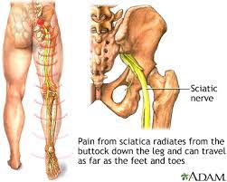 in depth reports back pain and sciatica