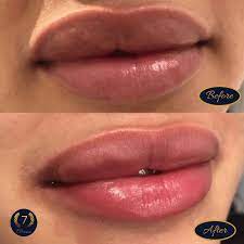 pink lips treatment with a laser
