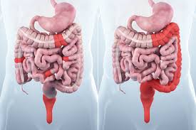 Incidence rates of ulcerative colitis and crohn's disease in fifteen areas of the united states. What Is The Difference Between Crohn S Disease And Ulcerative Colitis