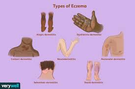 the 7 types of eczema symptoms and