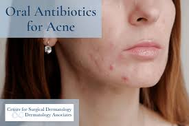 severe acne antibiotics for wiping out
