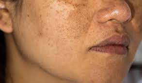 of hyperpigmentation around mouth
