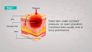 pressure ulcer causes ses