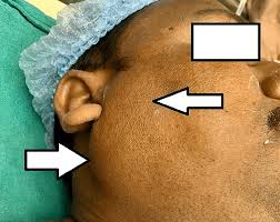 parotid gland after general anesthesia