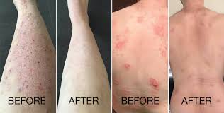Psoriasis is an autoimmune disorder speeding the turnover of skin cells, resulting in rashes or lesions. Natural Ways To Relieve Your Psoriasis Salts Of The Earth