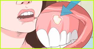 14 home remes to treat swollen gums