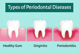 gum disease turmeric oil pulling