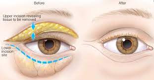 best eyelid surgery in pune dr rahul